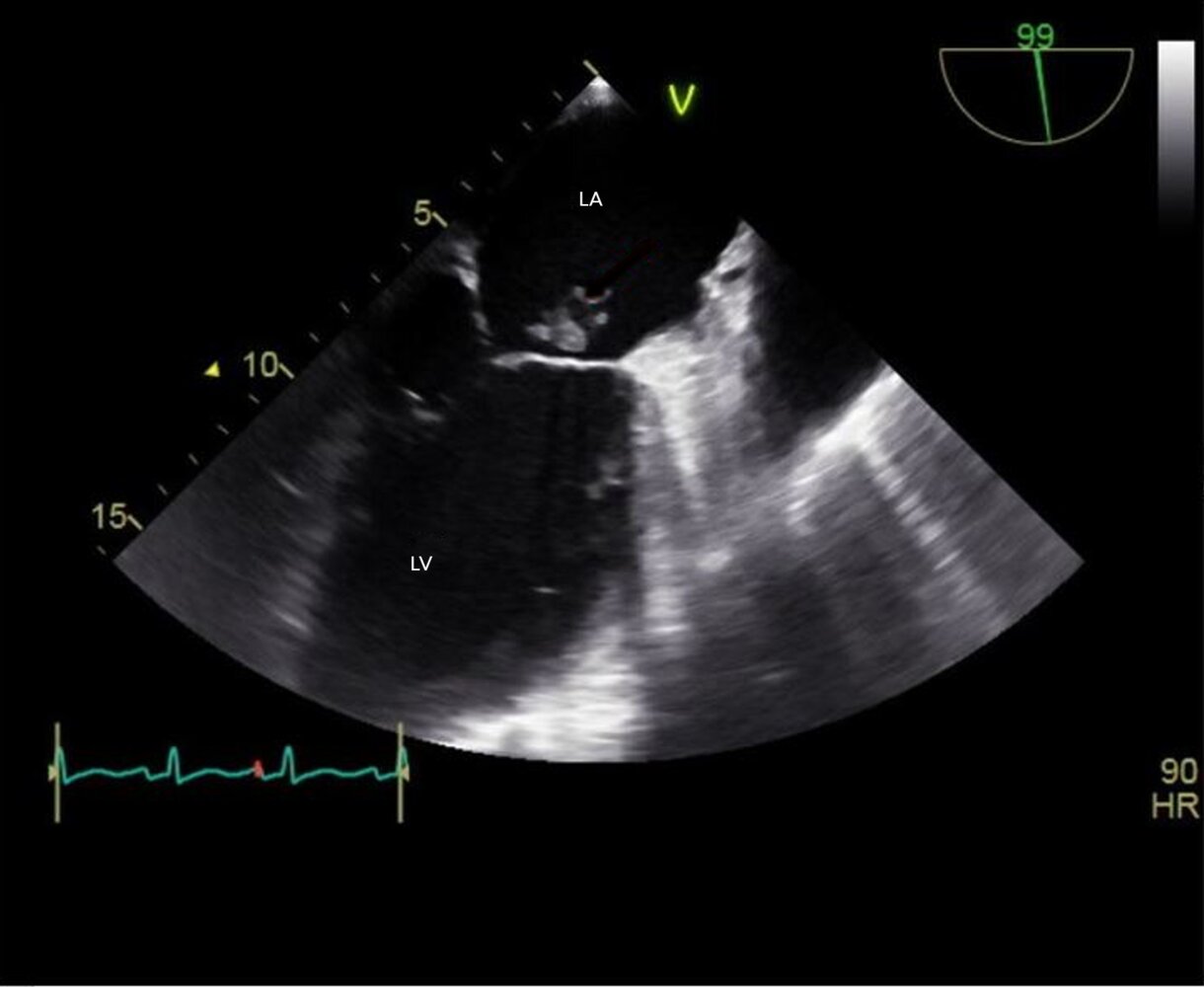 Bacterial endocarditis of the mitral valve