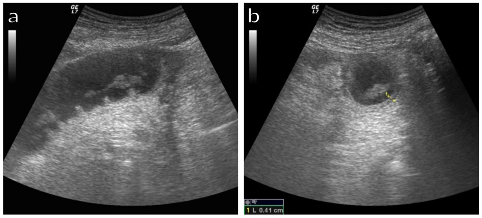 Bowel obstruction with free fluid