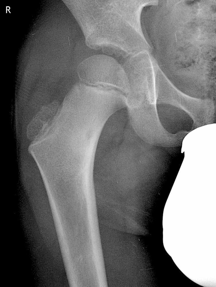 Osteoid osteoma