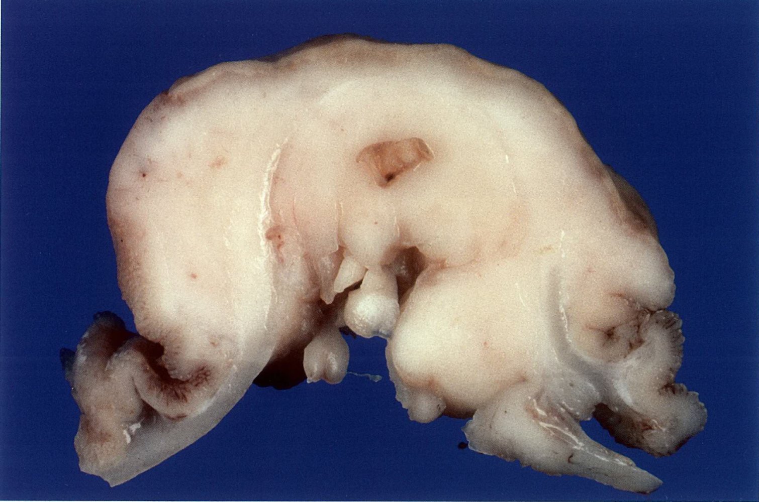 Non-Hodgkin lymphoma