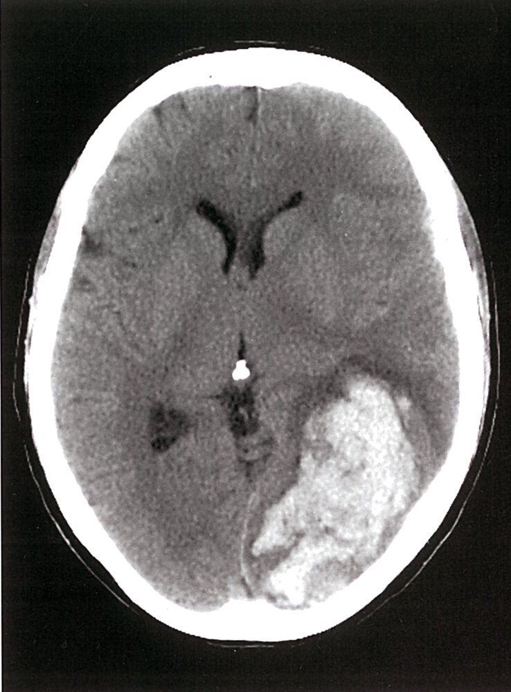 Intracerebral hematoma