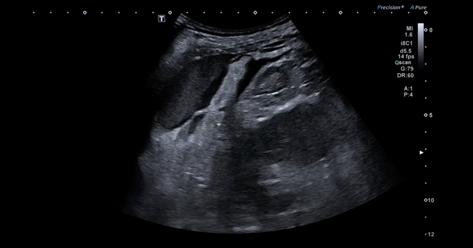 Free fluid in the splenorenal recess