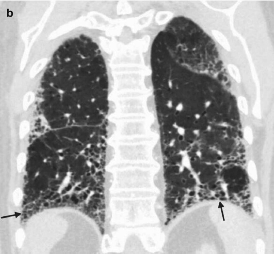 Idiopathic pulmonary fibrosis 2/2