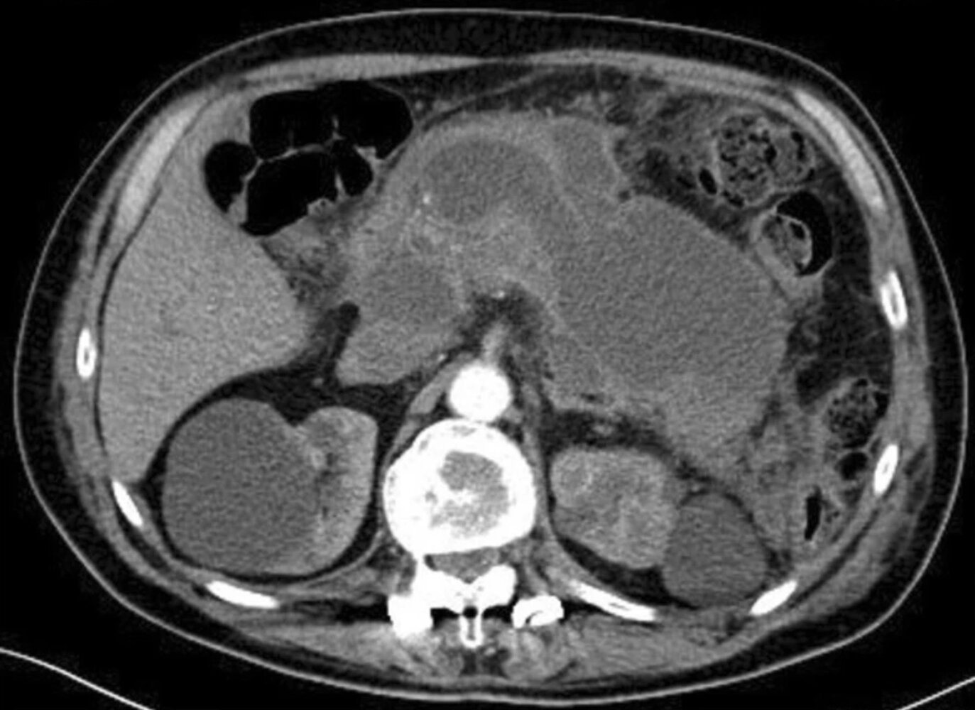 Pancreatic necrosis