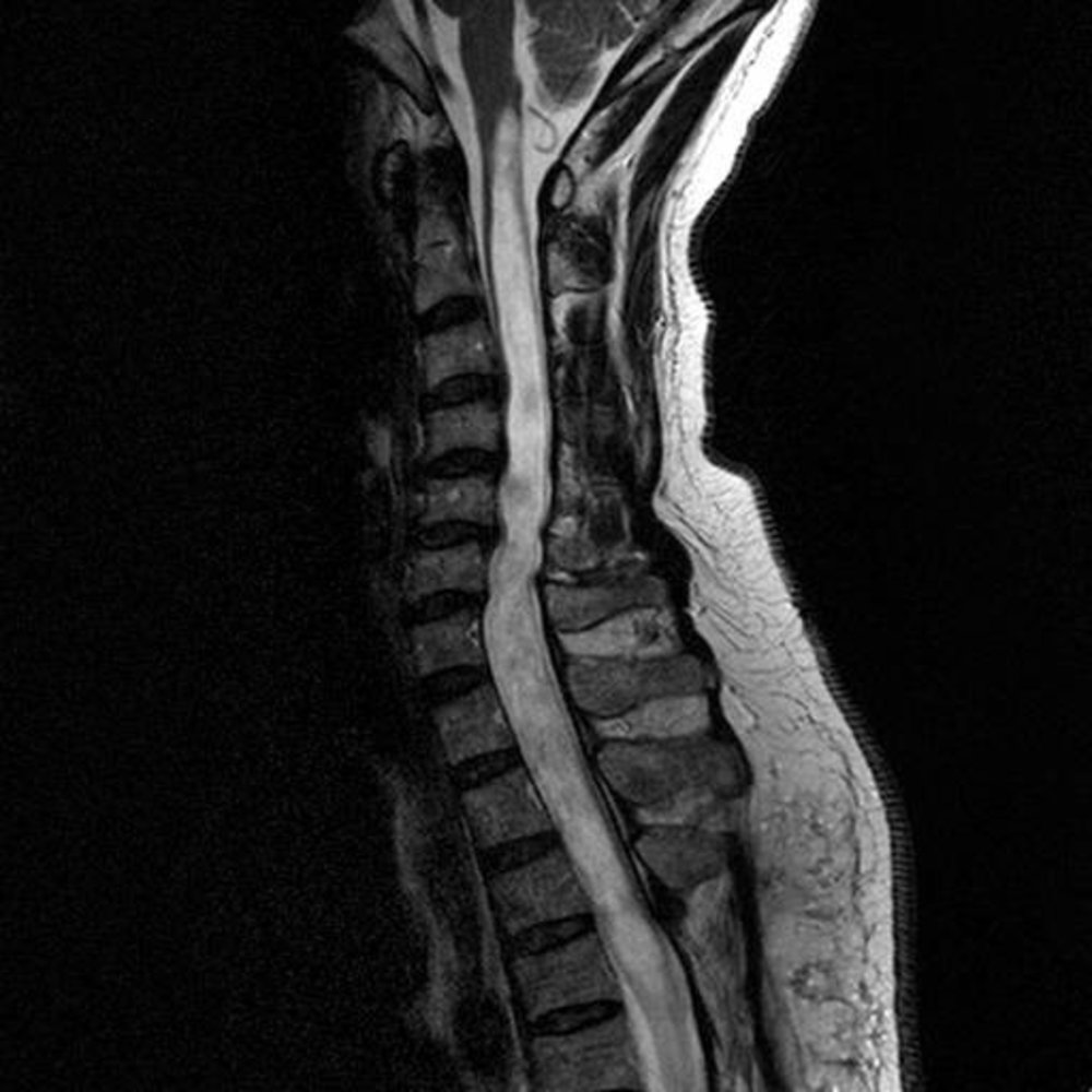 Syringomyelia