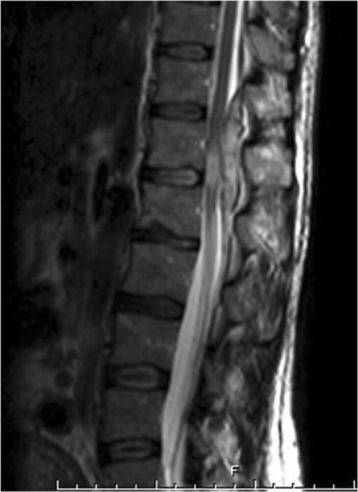 Spinal epidural hematoma