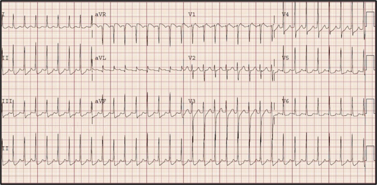 Atrioventricular nodal reentrant tachycardia (AVNRT)