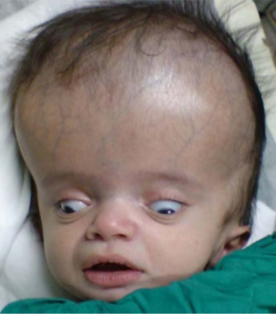 Hydrocephalus with sunset sign