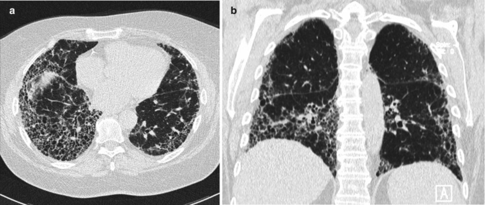 Usual interstitial pneumonia (UIP)