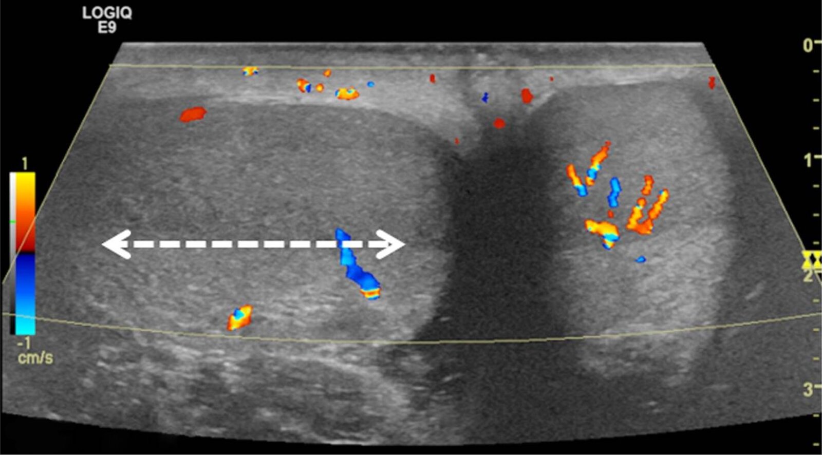 Intermittent testicular torsion
