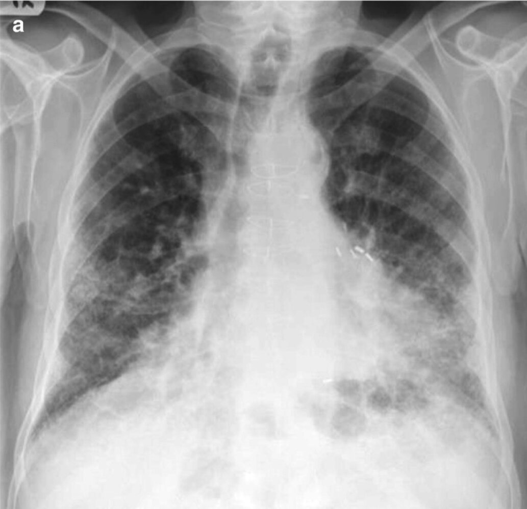 Idiopathic pulmonary fibrosis 1/2