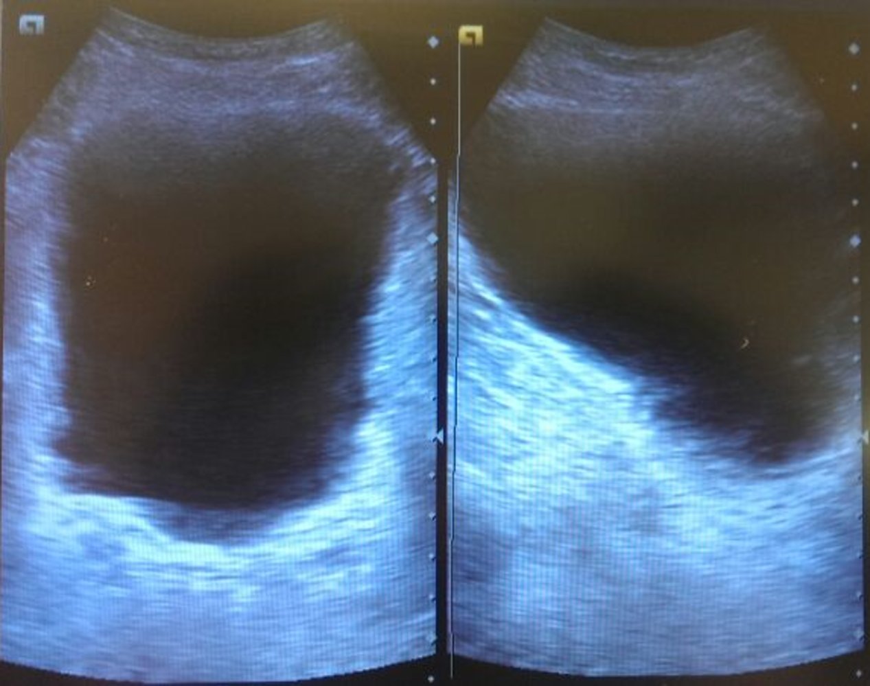 Distended bladder