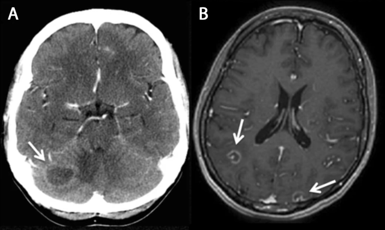 Intracranial toxoplasmosis
