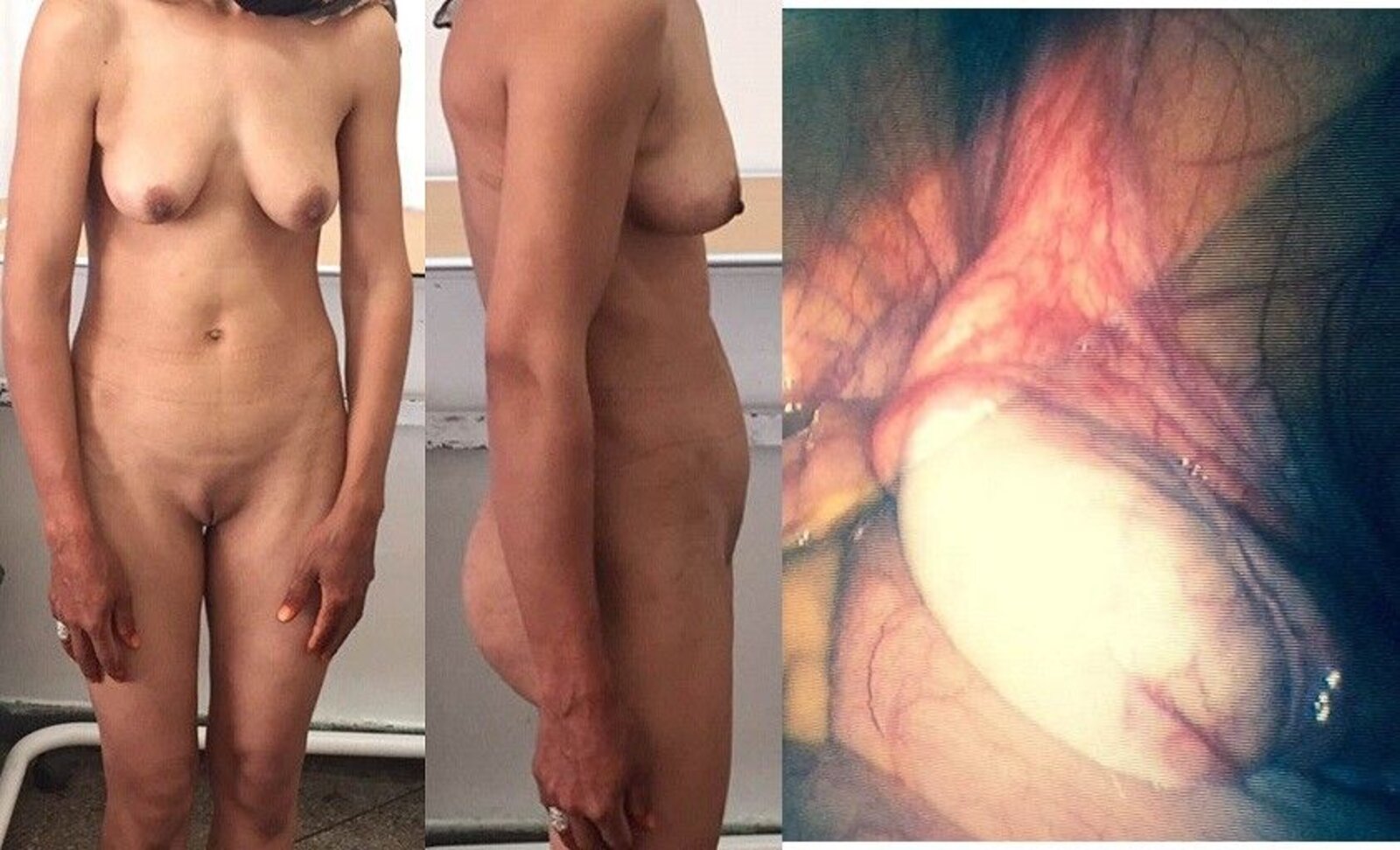 Complete androgen insensitivity syndrome (AIS)