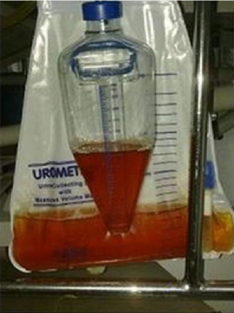 Orange urine secondary to rifampicin therapy