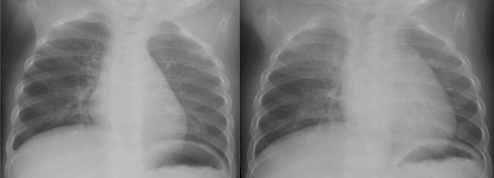 Foreign body aspiration