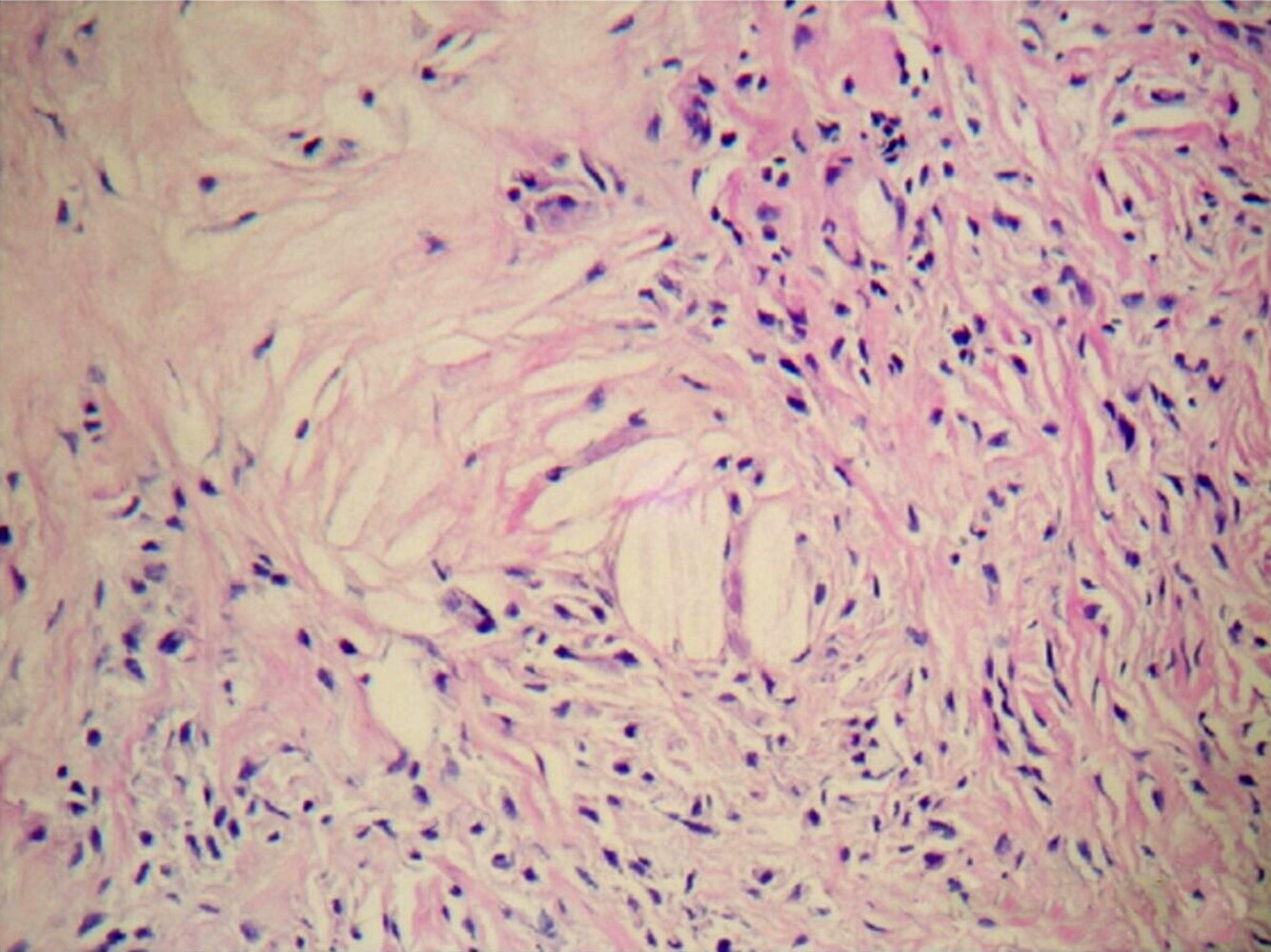 Xanthoma
