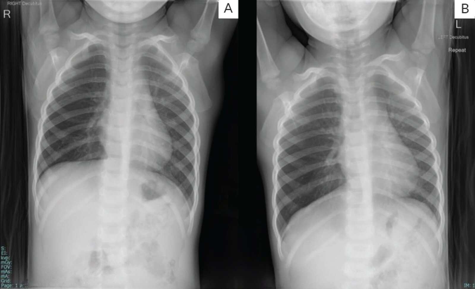 Foreign body aspiration