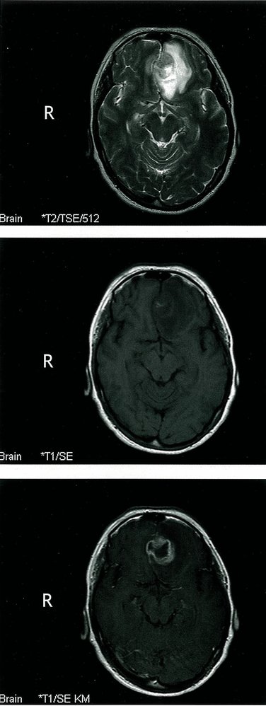Garland-like enhancement in glioblastoma