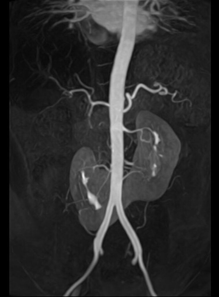 Horseshoe kidney