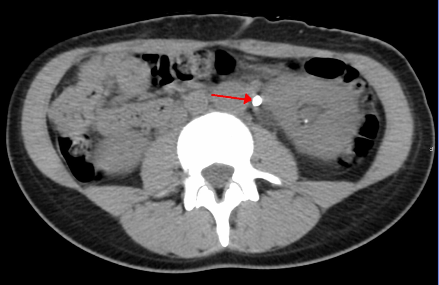 Ureter calculus with hydronephrosis