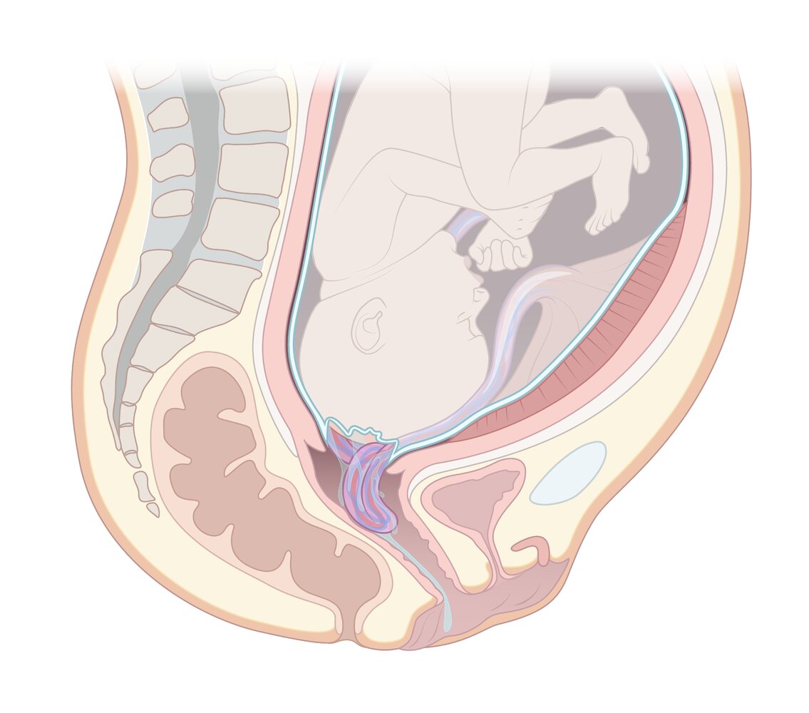 Overt umbilical cord prolapse