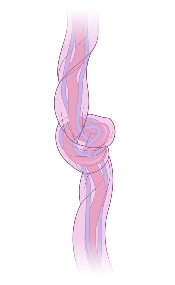 True umbilical cord knot