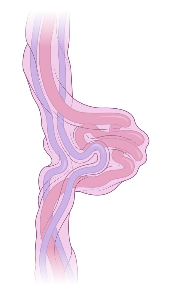 False umbilical cord knot