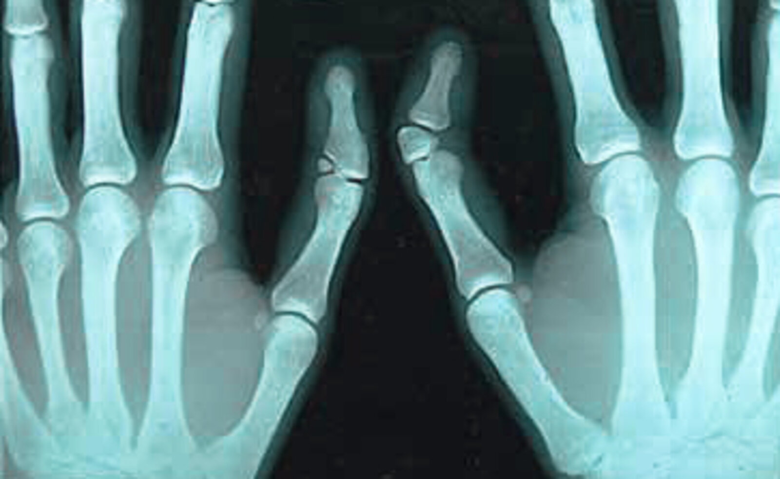Triphalangeal thumb