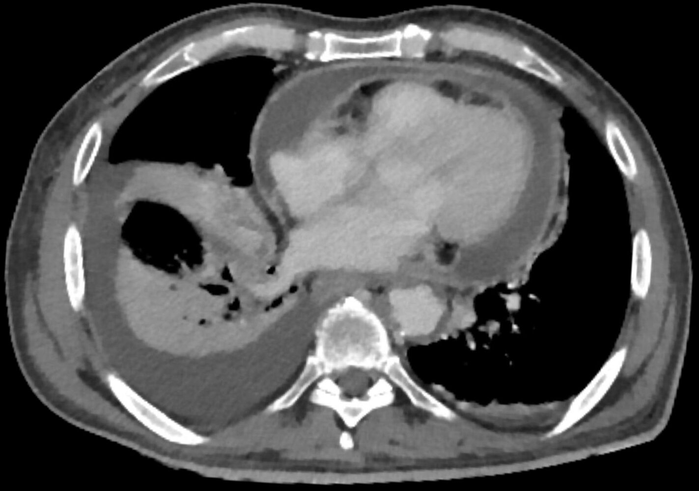 Pericarditis