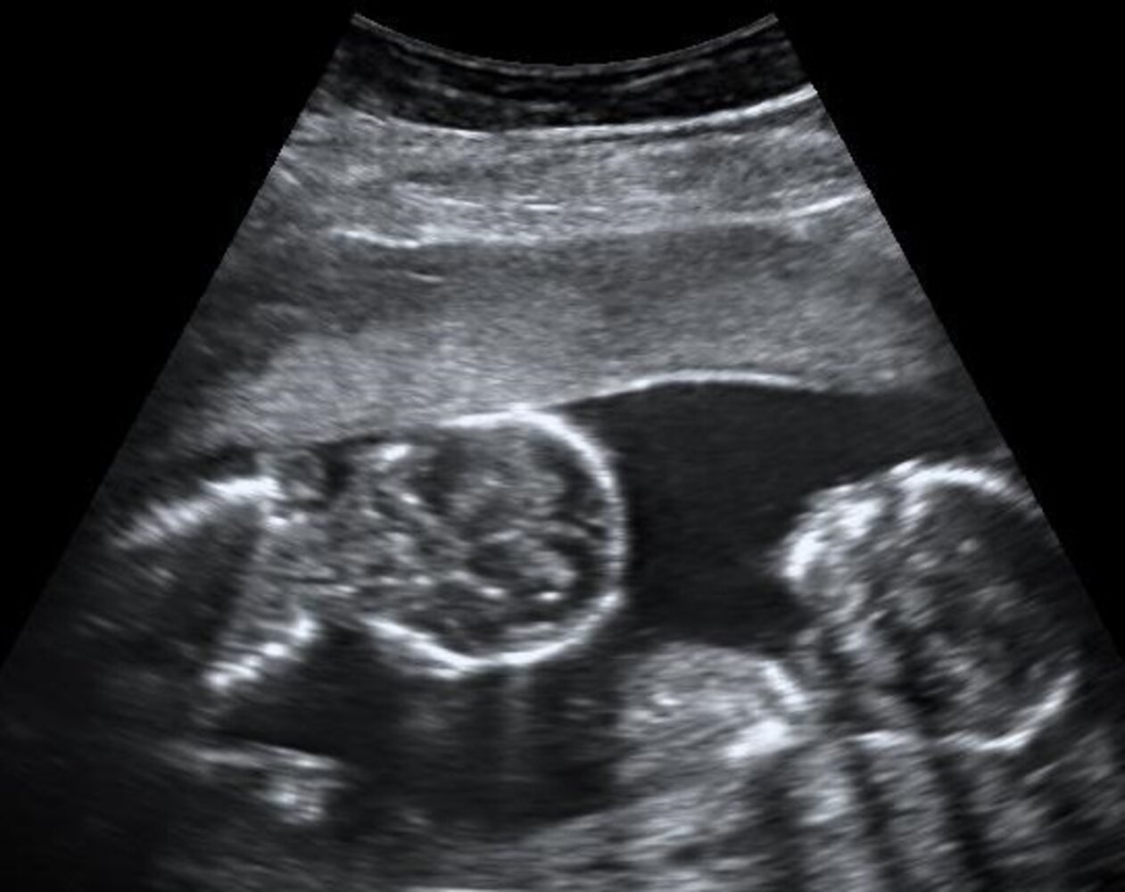 Monoamniotic twins