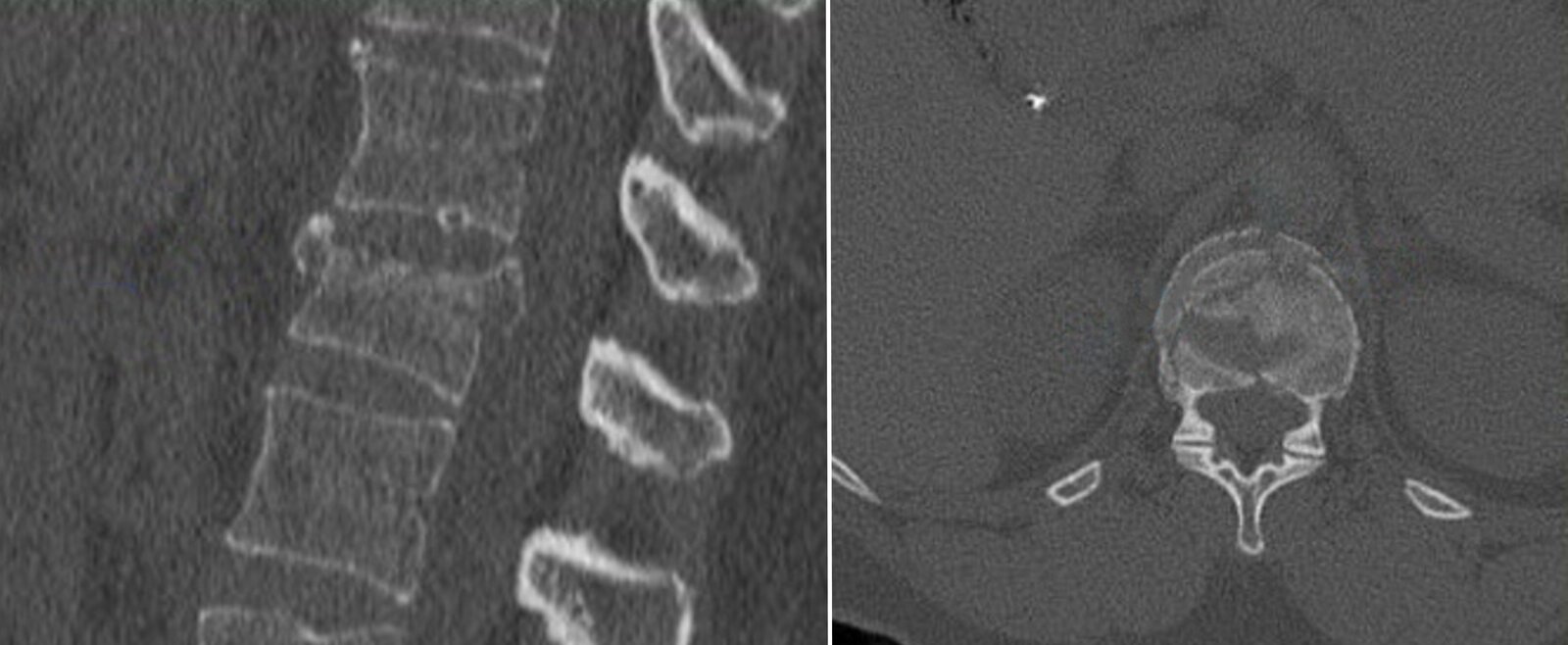 Burst fracture of T12 vertebral body