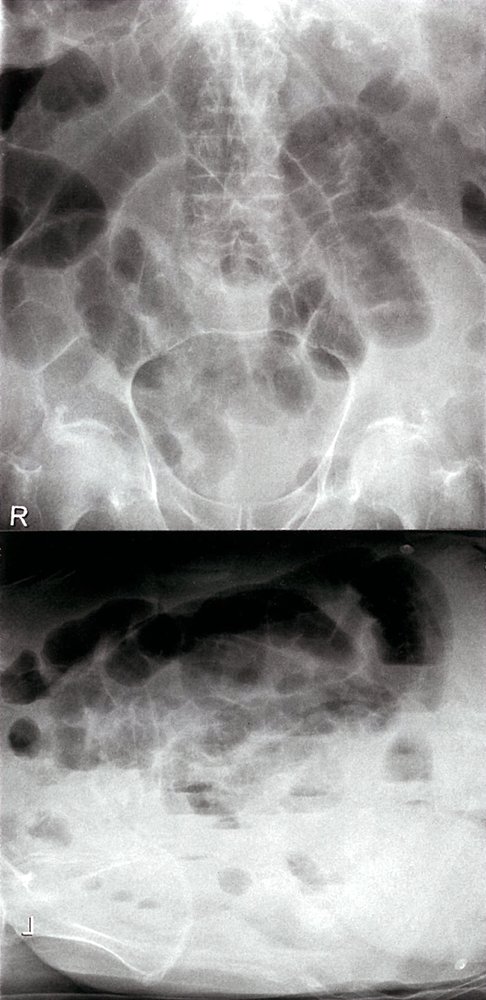 Paralytic Ileus