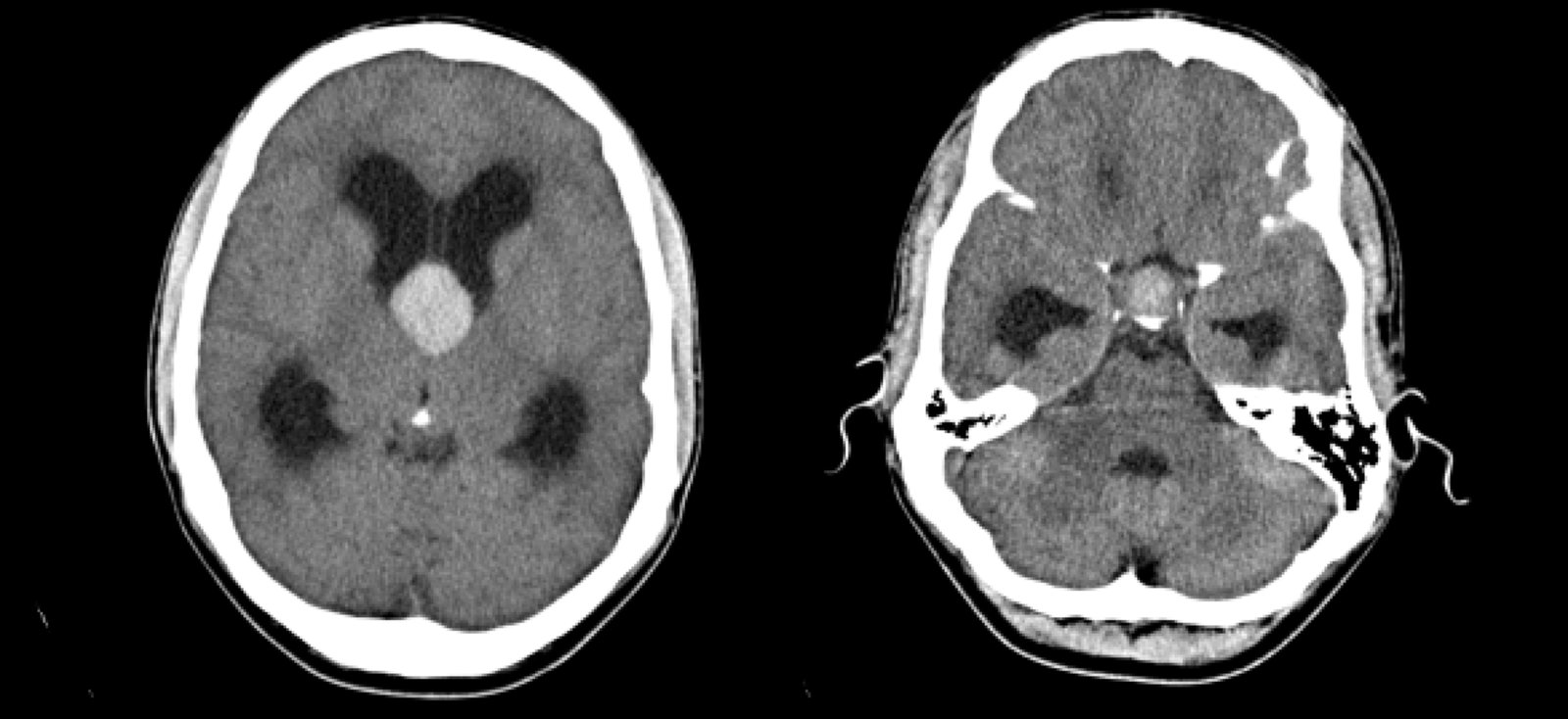 Pituitary mass