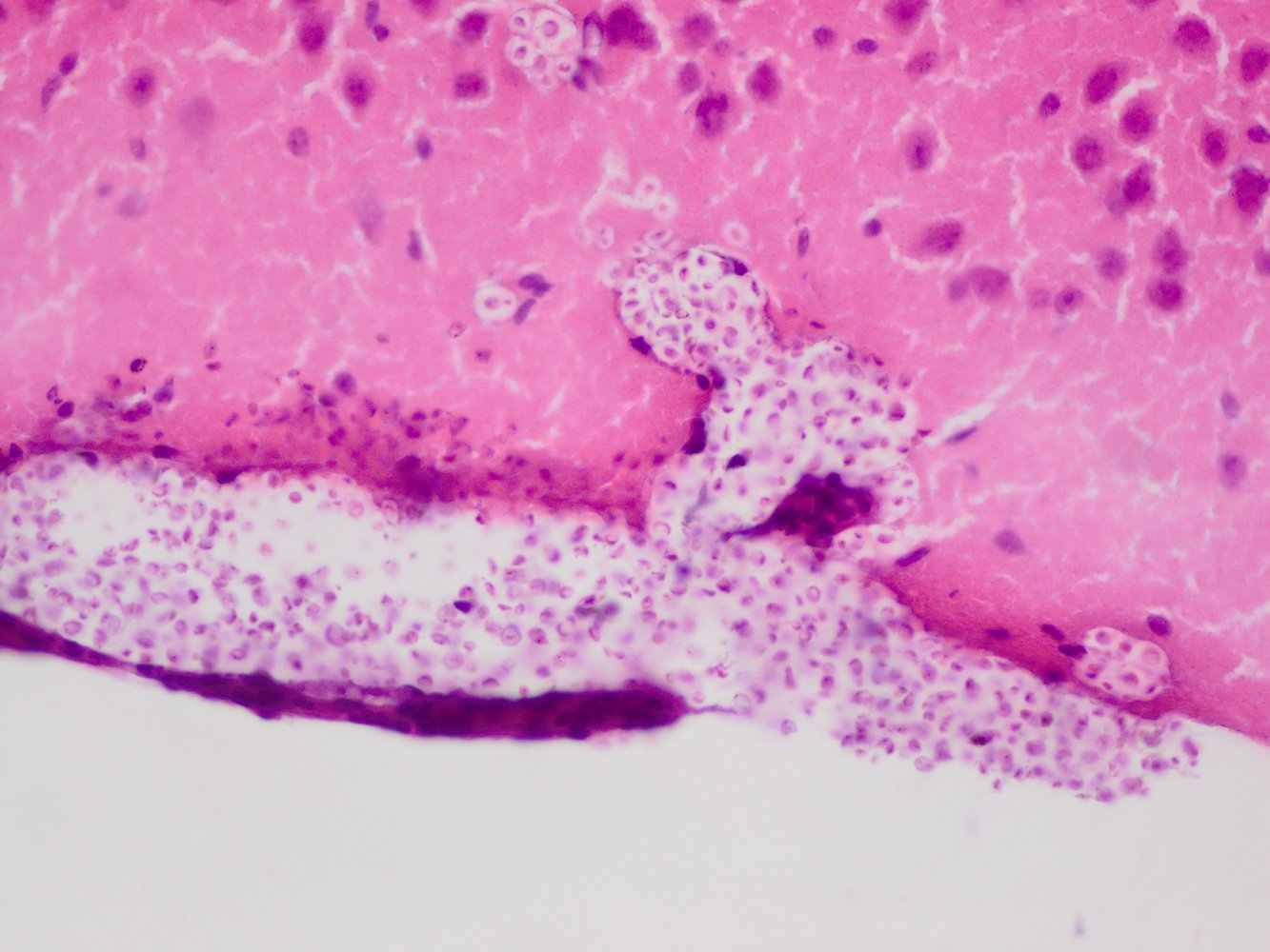 Cryptococcal meningoencephalitis