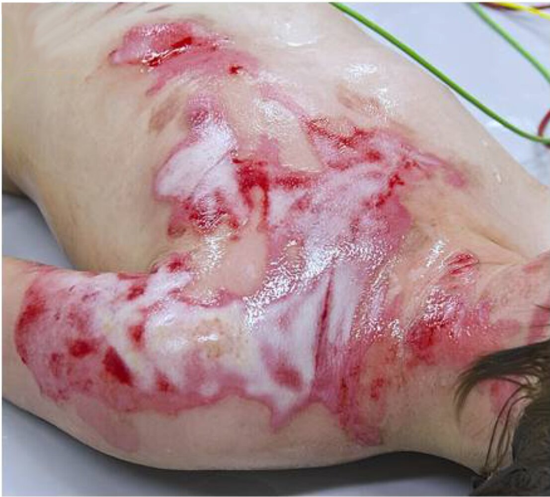 Second-degree scalding injury (2b; deep partial-thickness burn) after initial debridement