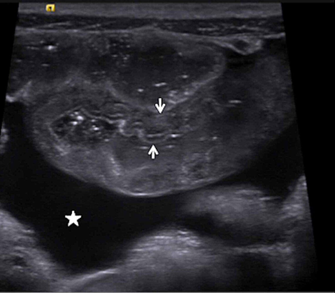 Bowel wall thickening