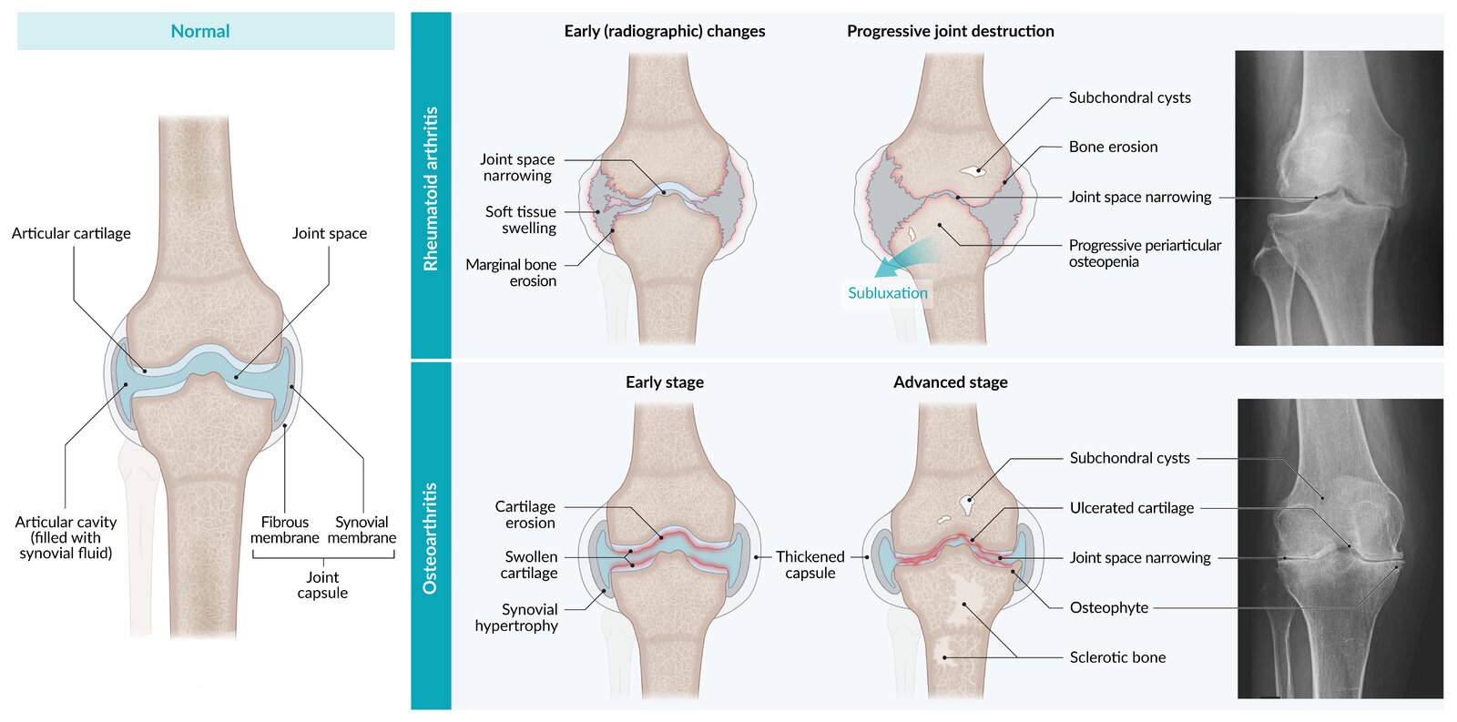Comparison of rheumatoid arthritis and osteoarthritis