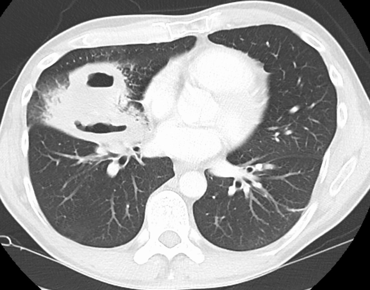 Lung abscess