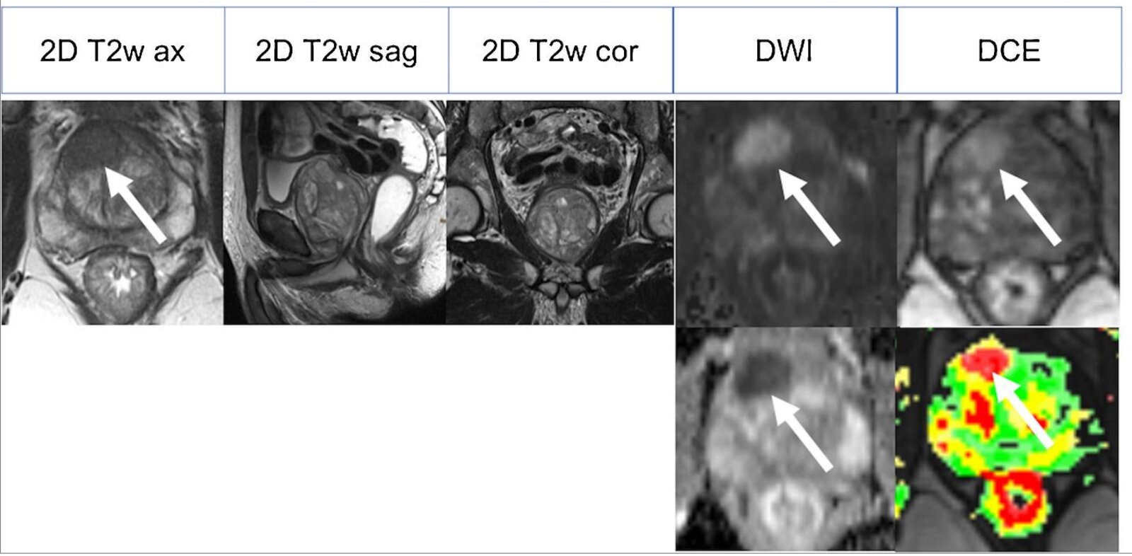Multiparametric MRI of prostate cancer