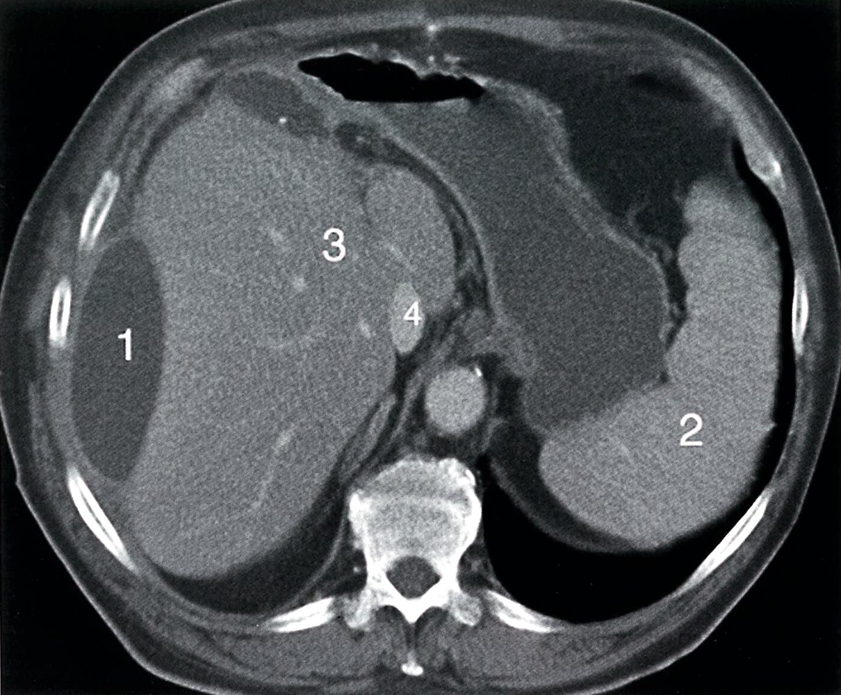 Subcapsular hepatic hematomas