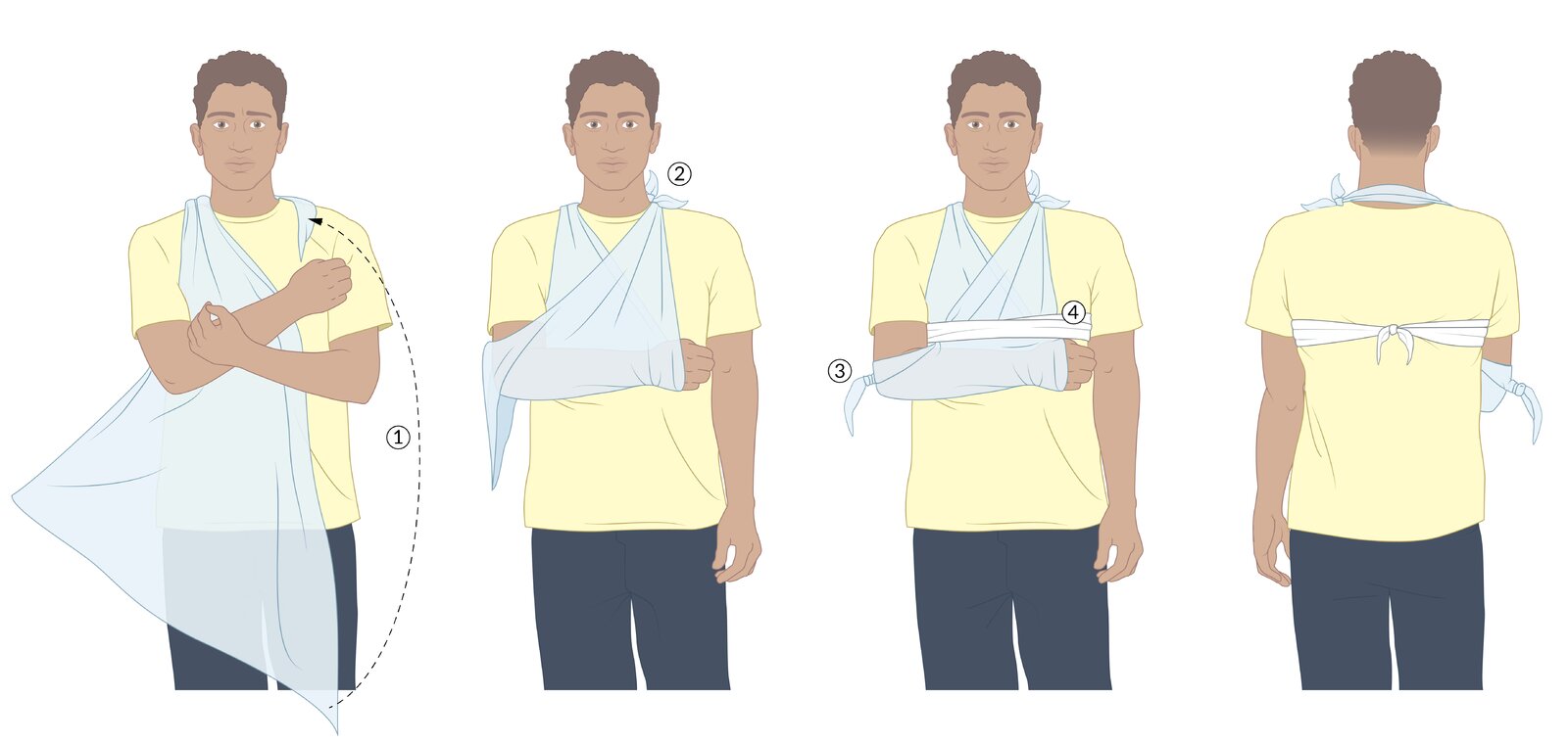 Broad arm sling using triangular bandage