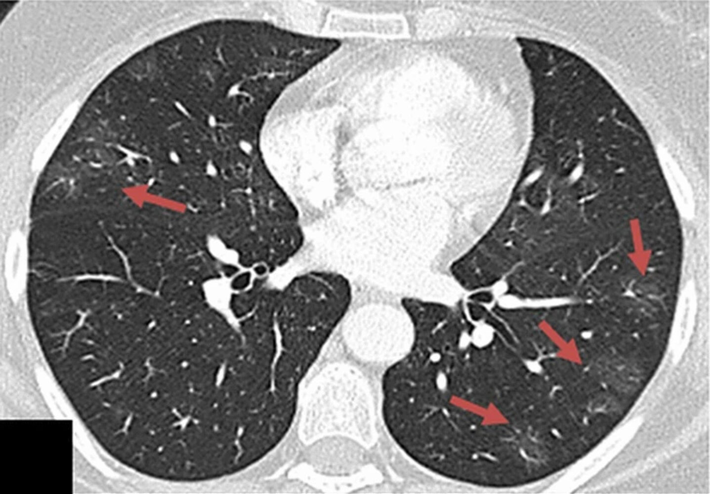 Multifocal ground-glass opacities