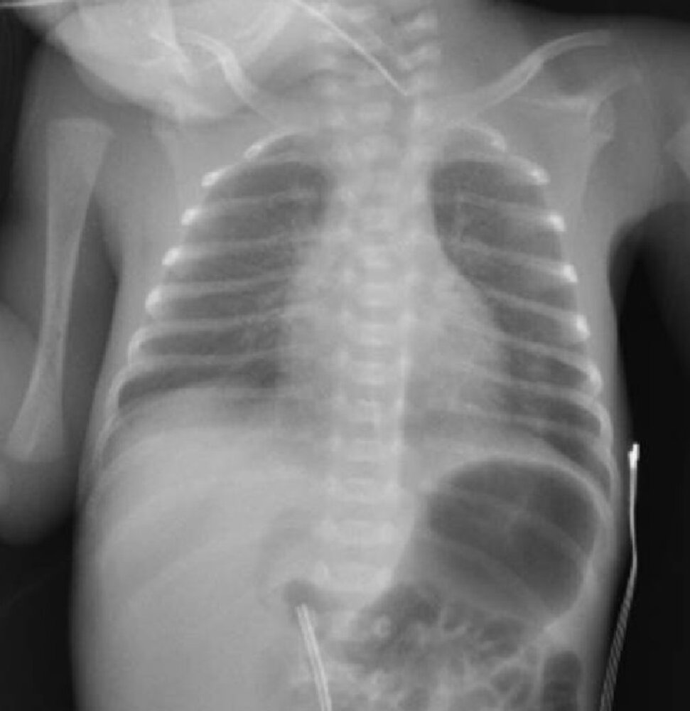 Neonatal respiratory distress syndrome