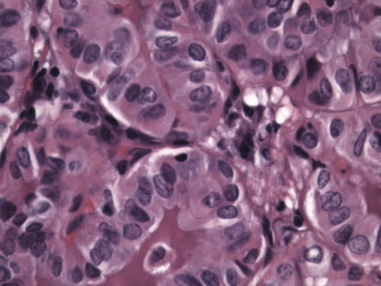 Nuclear grooves and Orphan-Annie eyes in papillary thyroid carcinoma