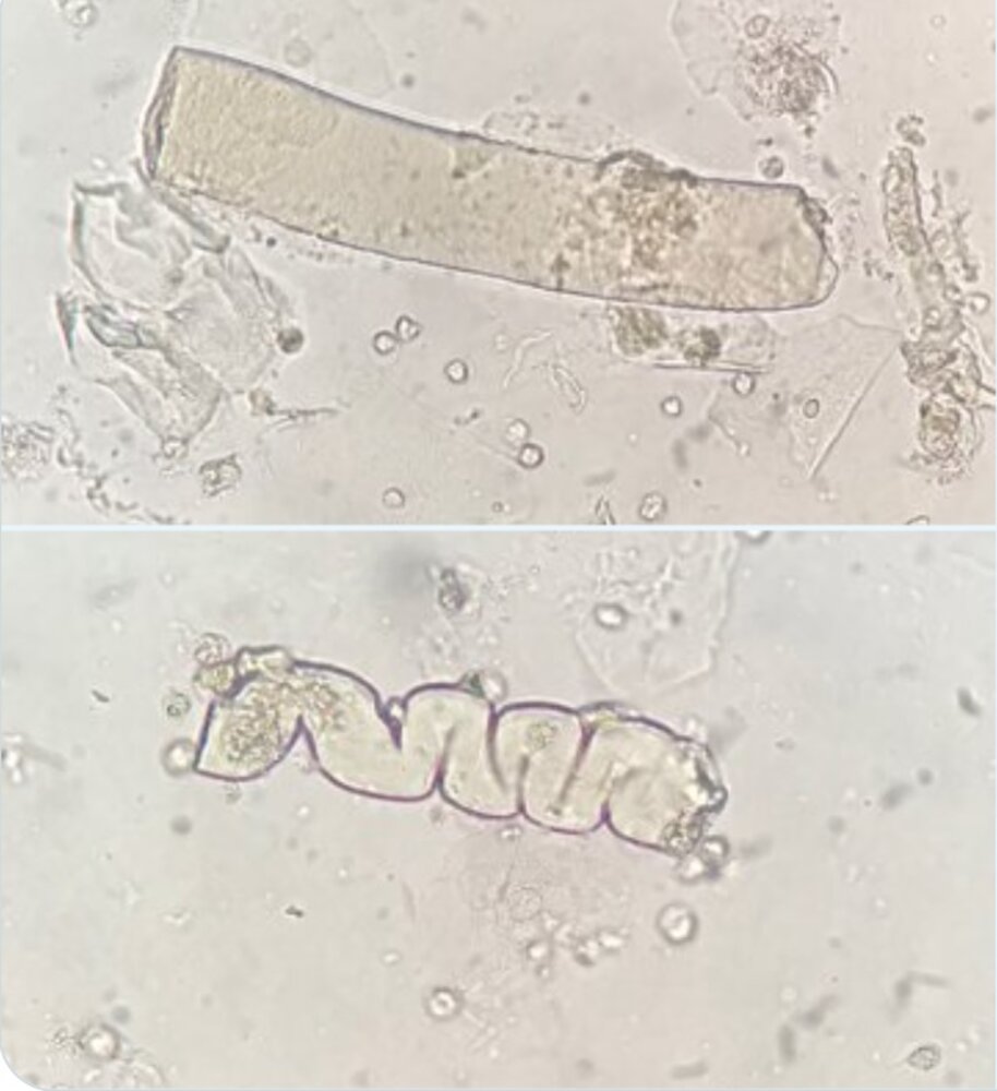 Waxy casts