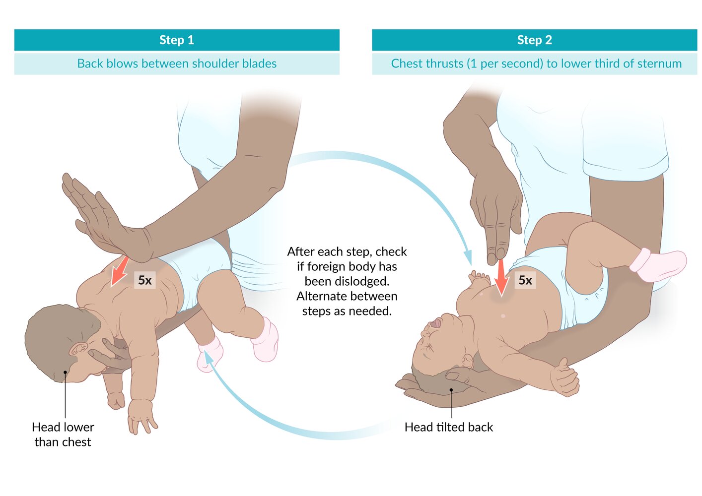 Back blows and chest thrusts in infants