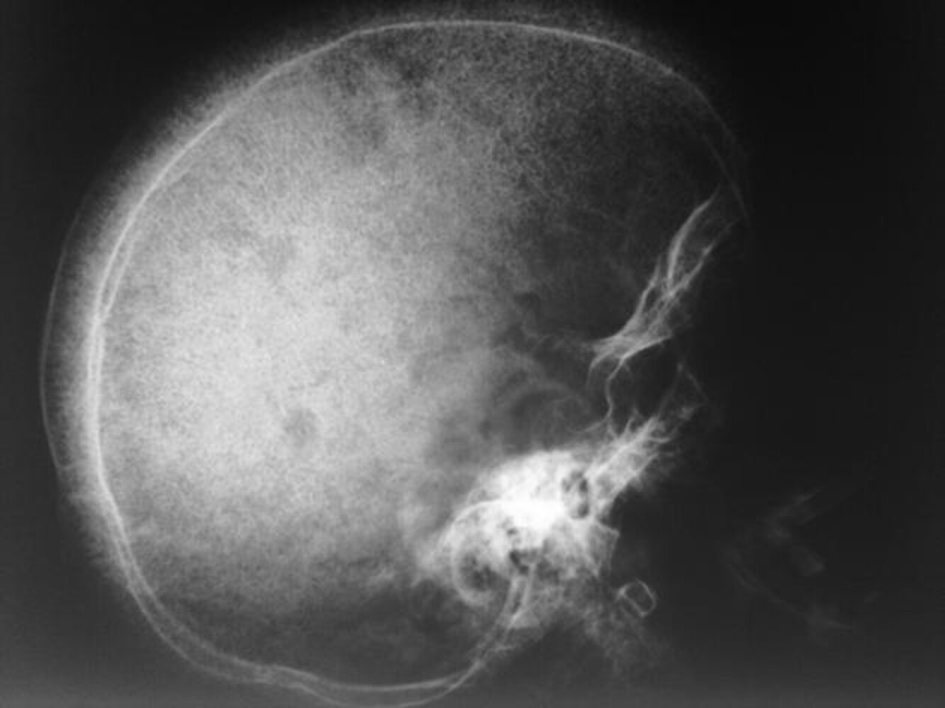 Hair-on-end appearance of the skull