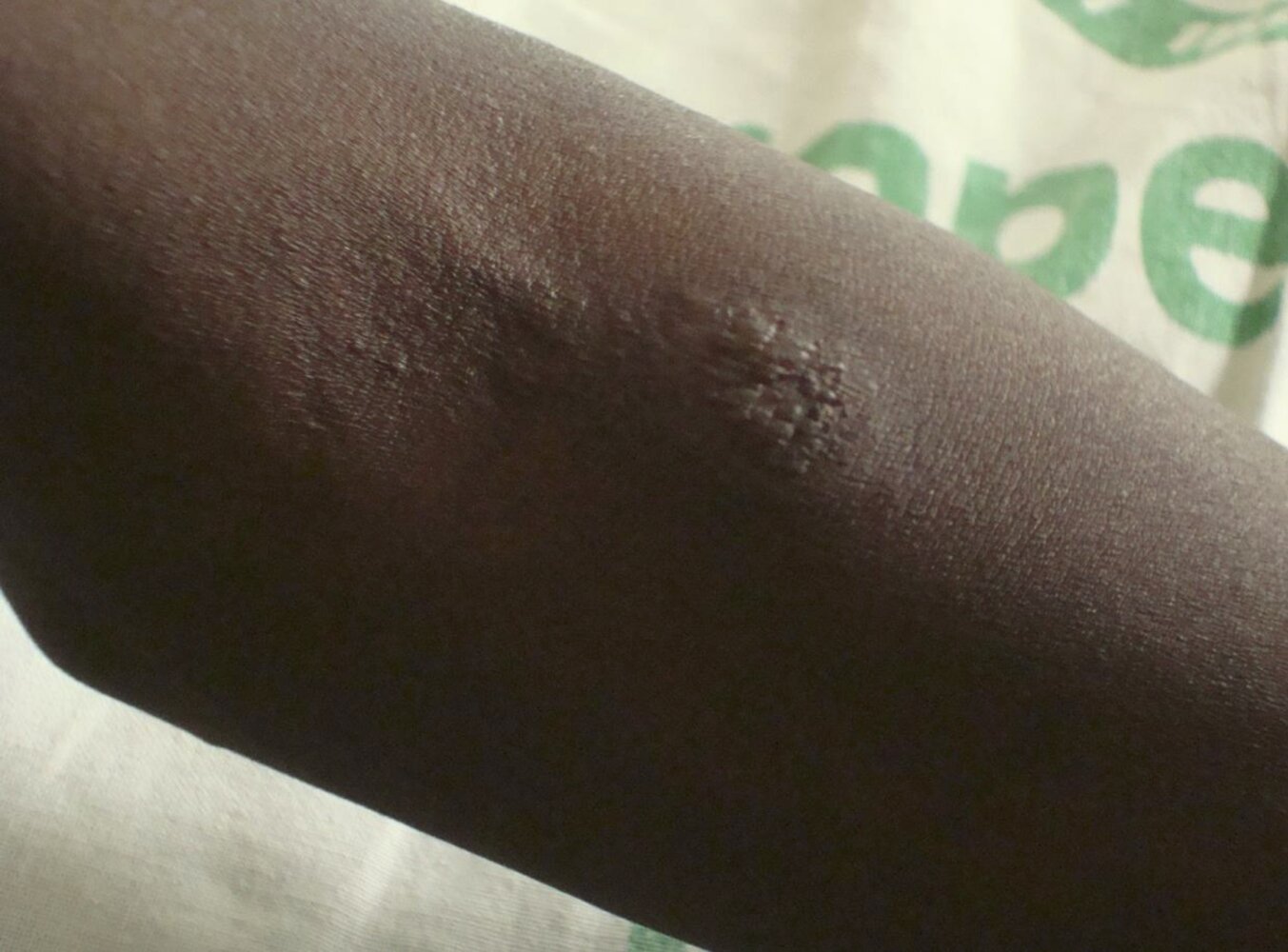 Positive Mantoux test