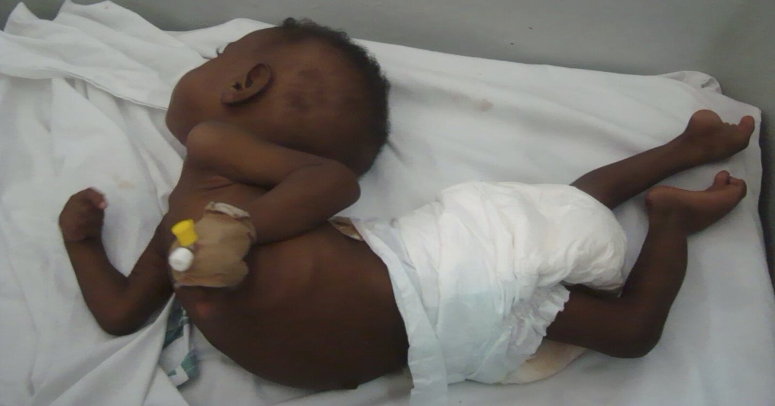 Tuberculous meningitis